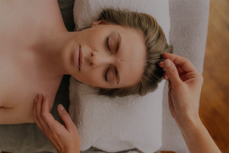 accupuncture